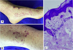 A, B) Purpuric macules and plaques with hematic crust that do not disappear on digital pressure located in the lower limbs. C) Skin biopsy with polymorphonuclear perivascular inflammatory infiltrate. H&E 40×.