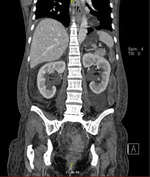 Bilateral dilatation of the ureters is observed.