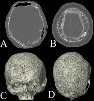 Simple skull tomography showing severe extensive involvement due to multiple lytic lesions in the cranial vault, including bilateral frontal, parietal, temporal and occipital involvement. (A, B) The axial sections in the bone window show lesions that compromise the outer table, the diploe and the inner table of the entire cranial vault. (C, D) The three-dimensional reconstruction of the tomography shows multiple lytic lesions that compromise the cranial vault in the outer table in its entire extension to the base of the skull.