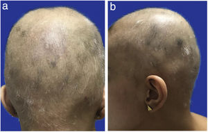 a) Alopecia areata at the beginning of treatment. Posterior. b) Alopecia areata at the beginning of treatment. Profile.
