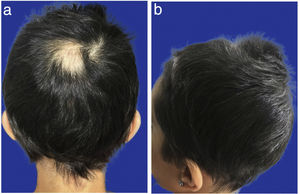 a) Alopecia areata after three months of treatment. Posterior. b) Alopecia areata after three months of treatment. Profile.