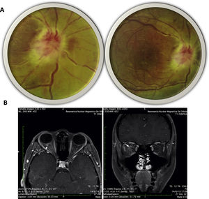 (A) Fundus image of the right eye: right optic disc with poorly defined edges, edematous, intumescent characteristics, flame epipapillary microhemorrhages, excavation of 0; there is evidence of effacement of the edges of the disc, areas of periphlebitis affecting the posterior pole and peripapillary retinal edema with some yellowish infiltrates in the posterior pole. (B) Contrasted MRI of orbits, T1 sequence with gadolinium in axial (right) and coronal (left) slices; enhancement of the optic nerve and sheath is evident (arrows).
