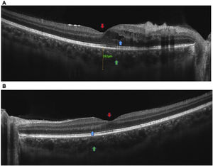 (A) OCT of the right eye: partial loss of the foveal contour (red arrow), presence of intraretinal cystic lesions predominantly in the inferonasal sector with foveal compromise (blue arrow), thickening and increased reflectivity of the internal segments of the nasal sector (vascular congestion), with slightly increased choroidal thickness, but with congestive choriocapillaris and dilation of Haller's vessels (green arrow). (B) OCT of the left eye: partial loss of foveal contour (red arrow), with thickening and increased reflectivity of the internal segments of the nasal sector (blue arrow), with slightly increased choroidal thickness, congestive choriocapillaris, and dilation of Haller's vessels (green arrow).