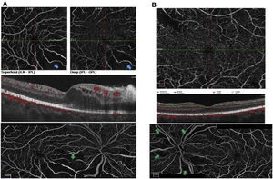 (A) Angio-OCT of the right eye: areas suggestive of hypoperfusion are observed at the inferonasal macular level, both in the superficial and deep plexus, which correlate with areas of macular edema (blue arrows). OCT-A reconstruction showing peripapillary vascular dilatation, areas suggesting hypoperfusion at the nasal and temporal peripapillary level, as well as at the inferonasal macular level (green arrow). (B) Angio-OCT of the left eye: deep plexus with areas of possible superotemporal hypoperfusion vs. artifacts, explained by whitish lesions. Reconstruction of the OCT-A angiography of the nerve and macula showing predominantly superior vascular dilatation, with peripapillary non-perfusion areas (green arrows).