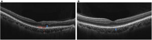 OCT of the macula in both eyes: control images after three months of follow-up. (A) Right eye: macula with alteration of the linear continuity of the layers of the juxtafoveal external retinal plexus, without involvement of the ellipsoid zone, with high reflectivity of the RPE/choriocapillaris complex with minimal atrophic changes (blue arrow). (B) Left eye: macula with normal architecture, with high reflectivity of the RPE/choriocapillaris complex and minimal atrophic changes (blue arrow).