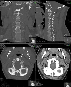 Axial, coronal and sagittal bone window and axial soft tissue reconstructions of a computed tomography scan showing an amorphous prevertebral calcification (arrows) anterior to the left side of the C1-C2 vertebrae probably located in the superior tendon of the longus colli muscle.