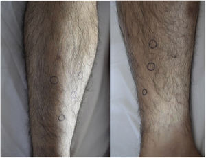 Presence of subcutaneous nodules of approximately 1.5–2 cm, slightly painful, rubbery, poorly defined and adhered to deep planes, without inflammatory signs or epidermal changes. The lesions were drawn to delimit their location.