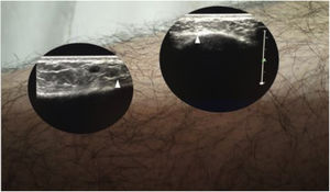 Soft tissue ultrasound showing increased thickness and striation of the subcutaneous cellular tissue with discrete poorly defined hyperechoic areas.