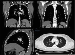 Chest computed tomography scan showing paratracheal, mediastinal, and hilar lymphadenopaties in both lung fields. Micronodules in the lower lobes of both lungs.