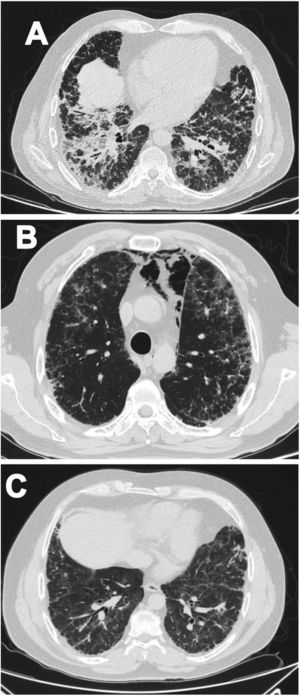 (A) Non-specific interstitial pneumonia pattern. (B) Pneumomediastinum. (C) Follow-up after one-year.