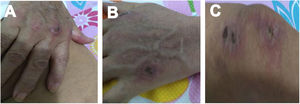 Cutaneous ulcer in metacarpophalangeal joints in the right (A) and left (B) hands, also in the knee (C).