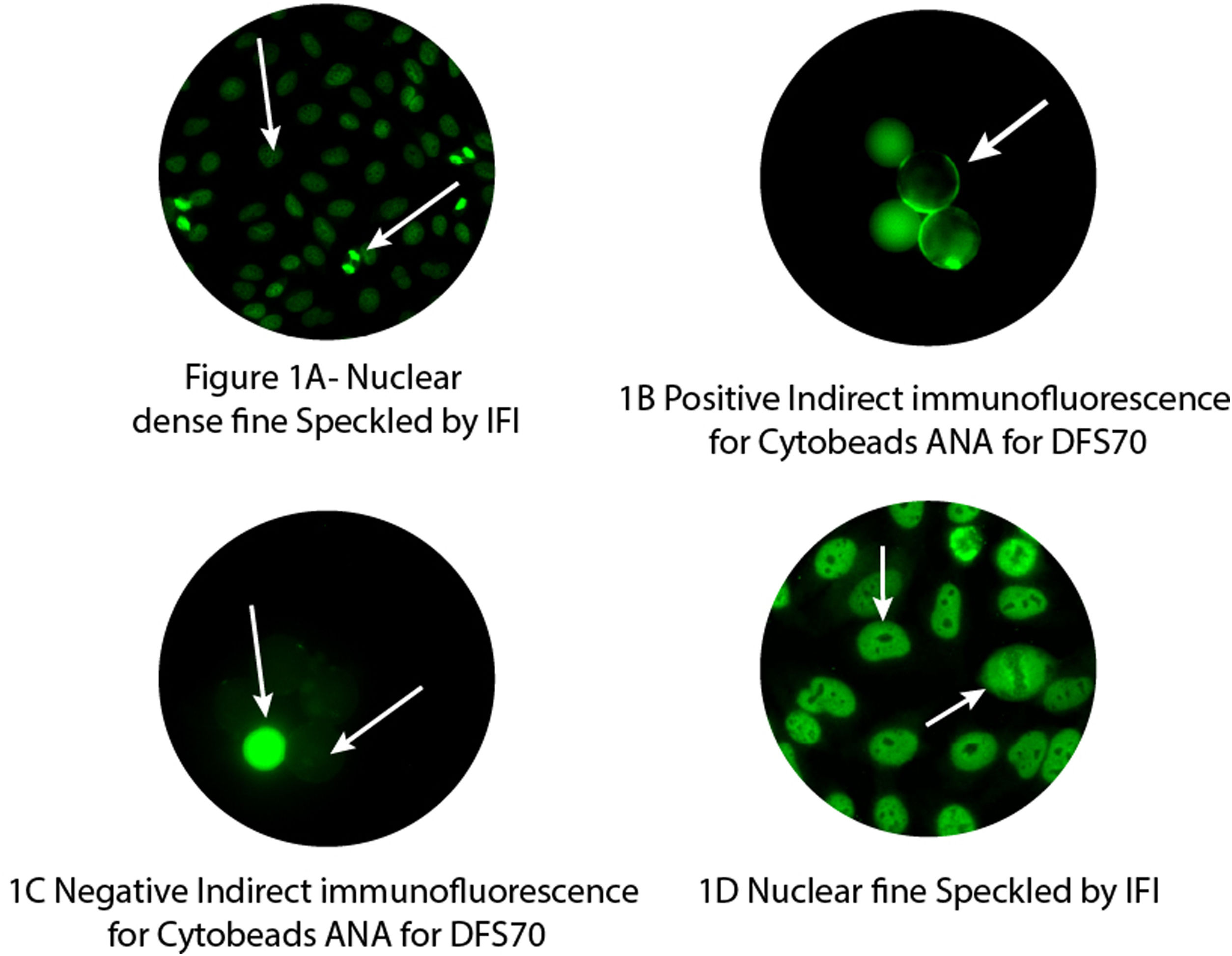 Ana Ifa Pattern Rim Frequency of ANA and ANA/DFS70 in patients diagnosed with psoriasis ...