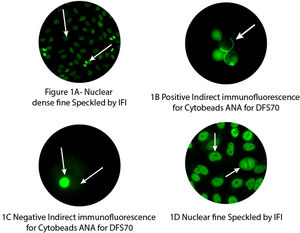 ANA and ANA/DFS70 in patients with psoriasis population by Indirect immunofluorescence technique. (A) Nuclear dense fine Speckled by IFI. AC-2 Speckled pattern distributed throughout the interphase nucleus with characteristic heterogeneity in the size, brightness and distribution of the speckles. Throughout the interphase nucleus, there are some denser and looser areas of speckles (very characteristic feature), typically excluding the nucleoli with bright staining of the chromosomes in mitotic cell phase. 40×. (B) Positive Indirect immunofluorescence for Cytobeads ANA for DFS70. Positive antibodies in diluted patient samples react specifically in the first step with antigens on beads fixed onto slides/Cytobeads ANA for DFS70. Ring fluorescence of the antigen coated beads shows the presence of DFS70. 40×. (C) Negative Indirect immunofluorescence for Cytobeads ANA for DFS70. The absence of ring fluorescence of the antigen coated beads shows a negative result regarding this antibody. Only fluoresces the Reference beads (Control). 40×. (D) Nuclear fine Speckled by IFI. AC-4 Fine tiny speckles across all nucleoplasm. The nucleoli may be stained or not stained. Mitotic cells have the chromatin mass not stained. 40×.