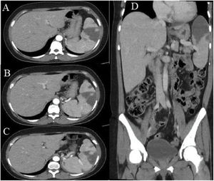 Contrast-enhanced abdominal tomography. A) Axial section, portal phase. A hypodense, wedge-shaped hypocaptive image is seen, with a tip oriented towards the hilum in the anterosuperior aspect of the splenic parenchyma. B) and C) Multiple hypodense hypocaptive images: the largest wedge-shaped with a tip oriented towards the hilum in the anterosuperior aspect of the splenic parenchyma and the others smaller. D) Coronal reconstruction. Multiple hypocaptive images are evident, the largest of them located predominantly in the upper pole of the spleen, wedge-shaped in the splenic parenchyma and pointed towards the hilum, which covers 40% of the volume of the spleen corresponding to splenic infarcts.