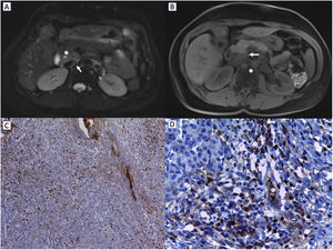 MRI imaging: (A) Axial fat-suppressed (FS) T2-weighting image shows an area of a slight hyperintensity in the pancreatic uncinate process (white arrow), with an infiltrative pattern respecting the pancreatic margins and a patent pancreatic conduit (white asterisk). (B) Axial FS T1-weighting image shows a hypointensity in the pancreatic uncinate process, with a well-perfect delimitation of the rest of the tissue (white arrow). Besides, some peripancreatic and portacaval lymphadenopathy are observed (white asterisk) (C). In immunohistochemical stains, ≥100cells were positive for IgG, and (D) ≥40cells were positive for IgG4 per high power field.