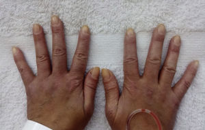 Gottron papules. Erythematous papules and macules over the metacarpophalangeal joints that extend along the dorsal aspect of the phalanges of both hands, compatible with Gottron papules. Periungual erythema is also evident on both hands.