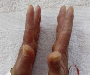 Mechanic’s hands. Hyperkeratosis and skin fissures are evident in the radial side of the first and second fingers of both hands. Image compatible with the “mechanic’s hands” sign.