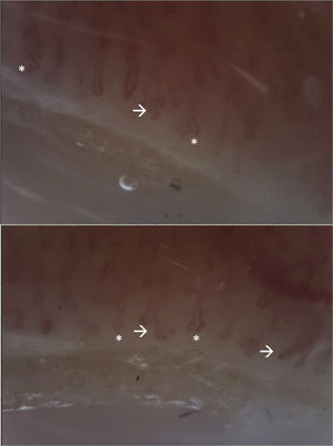 Video-capillaroscopy. Vascular bed with marked papillary edema, linear tortuosities and on its same axis (*), without microhemorrhages or megacapillaries. Branches are evident (arrow). Abnormal pattern, corresponding to non-sclerodermal pattern. The presence of multiple branches suggests the presence of dermatomyositis.