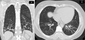 Chest CT scan with findings of ILD. Chest tomography in coronal (A) and axial (B) sections. Ground glass of peribronchovascular distribution is evident, with greater involvement of posterior segments and lower lobes, where reticulation, parenchymal bands, thickening of bronchial walls and traction bronchiectasis with associated volume loss are identified, due to retraction of fissures. Findings compatible with fibrotic NSIP. Calculated extension of 30%.