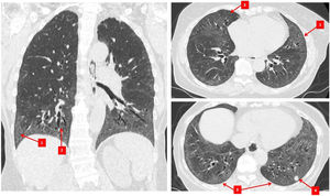 Chest HRCT features in SSc-ILD. Arrows indicate different radiographic features. (1) Ground glass opacification, (2) traction bronchiectasis, (3) subpleural sparing, and (4) lung nodule.