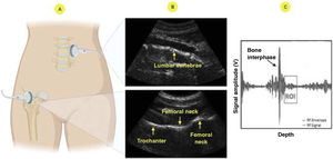 Radiofrequency Ecographic Multi Spectrometry scanning method: A) Ultrasound scan; B) Images of the lumbar spine and femoral neck; C) Identification of the region of interest (ROI) and subsequent analysis of the radiofrequency signals.