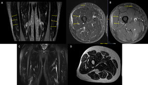 MRI findings. (A, B) MRI FIRST: Peri muscular fascia thickening overlying the vastus lateralis as well as the posterior thigh group. Such thickening shows post-contrast enhancement, also involving the semimembranosus muscle, the long head of the biceps, and, to a lesser extent, the semitendinosus. The coronal plane displays lateral fascial thickening and enhancement similar to the contralateral thigh. These findings suggest inflammatory fasciitis. (C, D) MRI CONTROL: total remission of the thickening and edema that once affected the fascia of the muscles of both thighs.