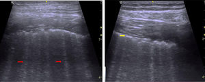 Lung ultrasound of the patient with findings of pulmonary interstitial disease. The red arrows point to B lines, while the granular pleural line is indicated with a yellow arrow.