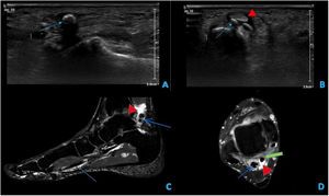 (A,B) Ultrasound images of the right foot showing anechoic fluid in the tendon sheath of the flexor propria of the big toe (flexor hallucis longus) in relation to tenosynovitis (red arrowhead), as well as hyperechoic foci within the sheath representing the calcified chondral foci (blue arrow). (C,D) MRI images of the right foot, T2 sequence with sagittal (C) and axial fat suppression located in the ankle (D). Fluid is observed in the sheath of the flexor tendon propria of the first finger (red arrowhead: liquid; green arrow: tendon) with numerous calcifications inside, both at its insertion and as it passes through the ankle, visualized as hypointense and rounded foci (blue arrows).
