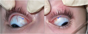 Micronodules in the superior bulbar conjunctiva in both eyes. Photos taken by the authors at the time of evaluating the patient in the hospital before surgery.