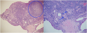 Biopsy of the superior bulbar conjunctiva of both eyes. Formation of granuloma (left) and multinucleated giant cells and chronic inflammatory infiltrate (right) are evident. Histopathology taken by the authors.