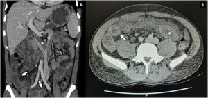 Contrast CT-scan of the abdomen. A) Coronal section, thrombosis of the inferior vena cava (asterisk) and edema of the ileum wall with target sign (white arrows). B) Axial section, target sign (white arrow) bowel dilatation (asterisk).