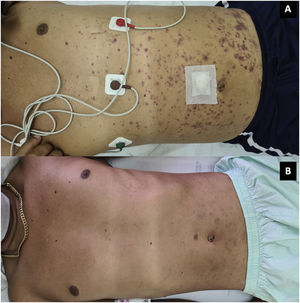 A) Palpable purpura on the trunk. B) Resolution of the lesions 72 h after the start of antifungals.