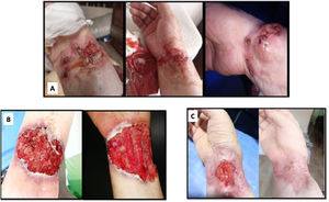 Evolution of the primary lesion on the right forearm. (A) Initial lesion with its progression prior to institutional assessment (photos taken by the patient and published under her consent). (B) Ulcer progression with deep tissue exposure during hospital stay (photos taken under patient’s consent). (C) Outpatient evolution under treatment with steroid and methotrexate (photos taken by the patient and published under her consent).