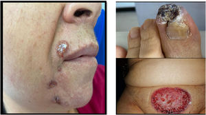 Lesions documented in the physical examination on admission to our institution. (A) In the right nasolabial region there is a small ulcer with yellowish cordoned edges. In the melolabial sulcus there are also two depressed brownish plaques of cicatricial aspect. (B) Distal necrosis of the hallux of the left foot. (C) Large ulcer in pubic and suprapubic region with violaceous borders, edematous to the cruciate periphery, and in the center with granulation tissue.
