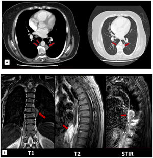 Paravertebral masses documented on imaging. (A) Contrasted chest CT: arrows indicate paravertebral soft tissue thickening, with a nodular lesion with soft tissue density of 18 × 18 mm, partially surrounding the aorta, prevertebral masses in T9, T11, and T12 in the mediastinal (left) and pulmonary (right) window, with nonspecific features. (B) Contrast MRI of the dorsal spine: hypodense bone marrow infiltrative lesions (arrows) in T1 and hypertensive with enhancement in T2 and STIR, involving the vertebral bodies T7, T10, T11, T12, and L1.