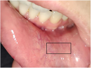 Reference image of the jugal mucosa in front of the lower left canine. The incision area is shown in the rectangle.