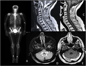 A) Bone scan showing symmetrical hyperenhancement deposits in the distal femoral and tibial diaphysis; B and C) extensive longitudinal transverse myelitis from C3 to C6, without contrast enhancement; D and E) patchy and diffuse hyperintensity in the bulb, pons, and cerebellar peduncles, with areas of patchy intraparenchymal enhancement.