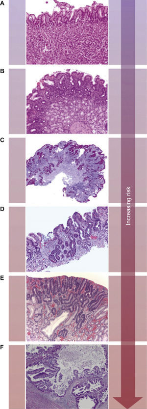 The Correa's cascade of multistep gastric carcinogenesis. The model describes a sequence of precursor conditions with increasing risk for development of intestinal-type gastric carcinoma. (A) Normal mucosa. (B) Chronic gastritis. (C) Chronic atrophic gastritis (Periodic-acid-Schiff-Alcian blue stain). (D) Intestinal metaplasia. (E) Dysplasia. (F) Intestinal-type gastric carcinoma. Adapted from: Hartgrink et al.3.