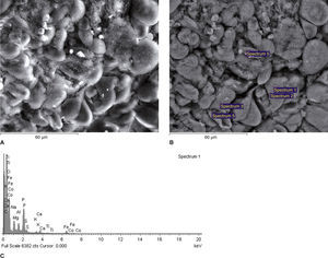 Scanning electron micrographs using secondary (A) and backscattered (B) electrons of an area of a kidney sample from a total nephrectomy renal cell carcinoma adjacent (control) tissue. All of the white spots in (B) are analyzed in Fig. 1C. It is possible to observe the difference in the qualitative composition of heavy metals of each sample. It is not possible to observe the presence of heavy metals in the control. Fig. 1C The spectrum reveals that the inclusion contains carbon (C, in the figure), which is used to coat the sample for SEM-XRM viewing, and it is also possible to see other normal chemical elements of cells such as Ca (calcium), P (phosphorus), O (oxygen), sulfur (S) and chlorine (Cl). X-ray microanalysis spectrum of an electron white spot is shown in the previous figure (backscattered electrons, (B).