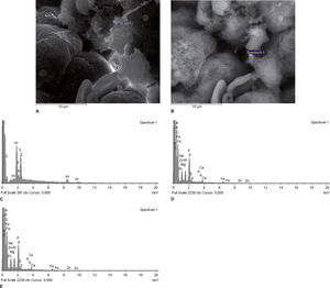 Scanning electron micrographs using secondary (A) and backscattered (B) electrons of an area of a kidney sample from a partial nephrectomy renal cell carcinoma tissue. All of the white spots in (B) are analyzed in Fig. 2C. Fig. 2C This spectrum (Fig. 2B) reveals that the inclusions contain carbon (C, in the figure), which is used to coat the sample for SEM-XRM viewing, S, P, but also tungsten (W), in amounts greater than 0.2-0.3% (m / m). Figures 2D and 2E Spectrums of X-ray microanalysis revealing that an intracellular particle observed by scanning electron microscopy contains Fe, Zn, Ca, K, S, P, Al, Mg, Zn and O. The analyzed dots were samples from a total nephrectomy renal cell carcinoma tissue.