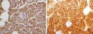 Immunohistochemistry study of the cells after bone marrow biopsy revealed expression of CD56 (not shown) and CD138 (A), and demonstrated cytoplasmic lambda light chain restriction (B).
