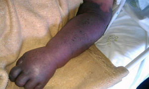 Cyanosis and marked oedema of the left upper-extremity.
