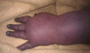 Cyanosis and marked oedema of the left hand.
