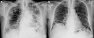 Thorax radiograph before admission (A) and after 2 months of discharge (B).