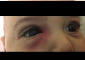 Redness swelling around right eye punctum.