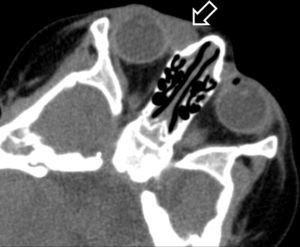 Orbital CT scan: axial image showing a cystic mass at the medial canthus.