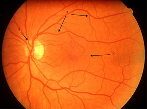 Clinical retinal photography image showing the normal appearance of the retina with the following structures: (a) optic disc, (b) macular area (responsible for the central 30 degrees of vision and (c) retinal blood vessels.