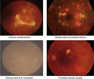 Clinical retinal photography images illustrating how sight-threatening noninfectious uveitis might manifest in the eye. Inflammation appears as pale white/yellow chorio-retinal spots and/or haziness with “floaters” in the vitreous gel, which fills the posterior chamber of the eye. Inflammation may lead to visual loss and blindness by causing pale, atrophic scarring of the retina, with exposure of the underlying black retinal pigment epithelium.