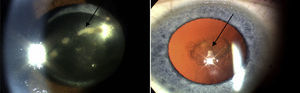 Complications of corticosteroid therapy: posterior subcapsular cataracts (a subtype of cataract/opacity of the crystalline lens, typically seen in patients on long-term corticosteroids).
