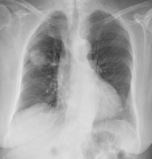 Chest radiography revealing a pulmonary mass in the right pulmonary third.